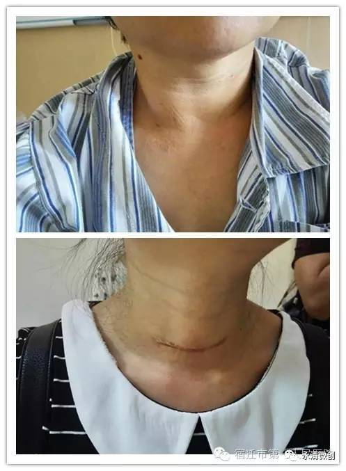 永清縣人民醫(yī)院外一科 引進(jìn)甲狀腺腫瘤無疤微波消融治療