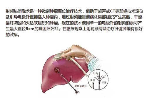 【永醫(yī)前沿】外三科順利完成“CT定位下肝腫瘤射頻消融手術(shù)”！