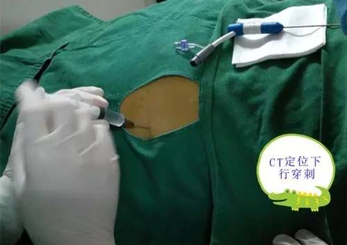 【永醫(yī)前沿】外三科順利完成“CT定位下肝腫瘤射頻消融手術(shù)”！