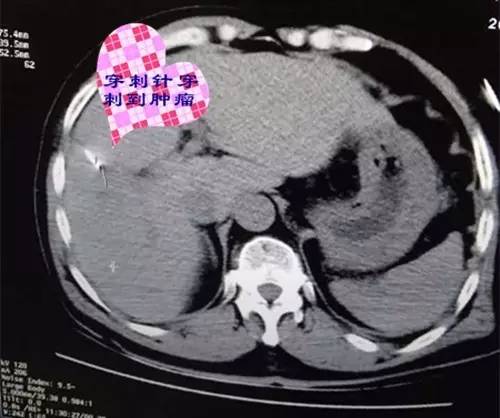 【永醫(yī)前沿】外三科順利完成“CT定位下肝腫瘤射頻消融手術(shù)”！