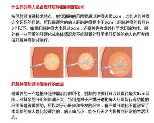 【永醫(yī)前沿】外三科順利完成“CT定位下肝腫瘤射頻消融手術(shù)”！