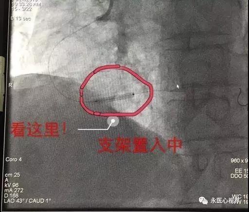 永清縣人民醫(yī)院內(nèi)二科介入治療中心