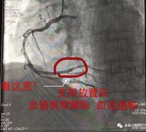 永清縣人民醫(yī)院內(nèi)二科介入治療中心