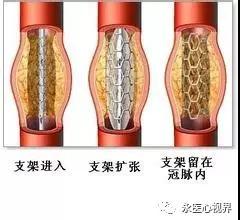 冠狀動(dòng)脈造影適應(yīng)癥