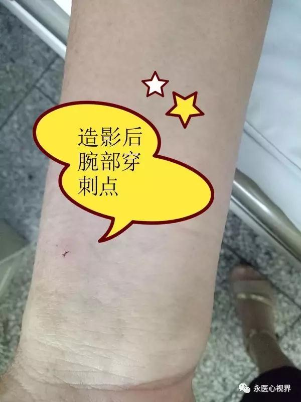 冠狀動(dòng)脈造影適應(yīng)癥