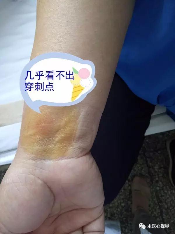 冠狀動(dòng)脈造影適應(yīng)癥