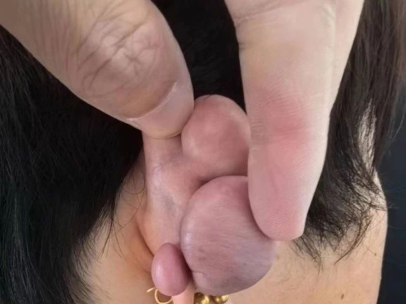 瘢痕疙瘩越來越大怎么辦？應(yīng)如何治療？