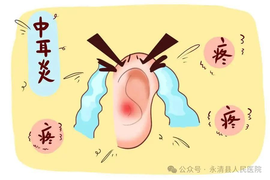 分泌性中耳炎——不流膿的中耳炎